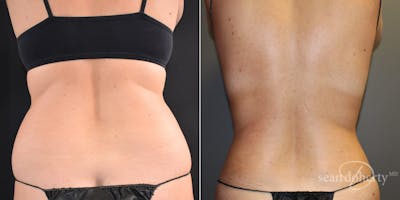 Liposuction Before & After Gallery - Patient 190428 - Image 1