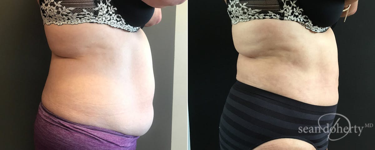 Liposuction Before & After Gallery - Patient 271327 - Image 3
