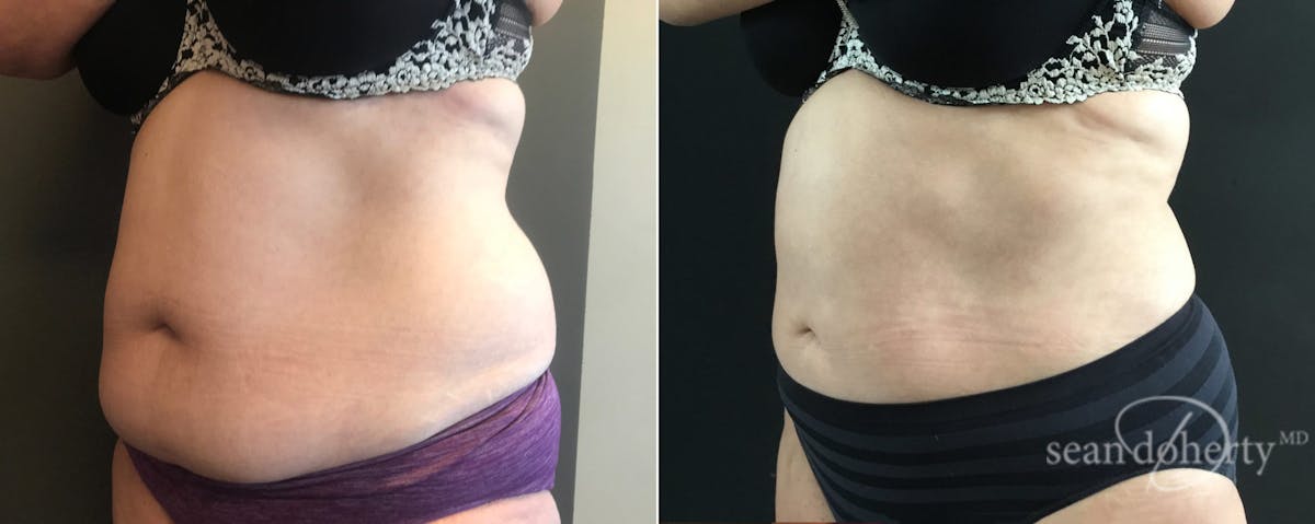 Liposuction Before & After Gallery - Patient 271327 - Image 2