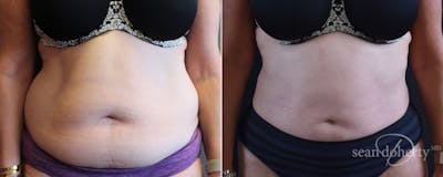 Liposuction Before & After Gallery - Patient 271327 - Image 1