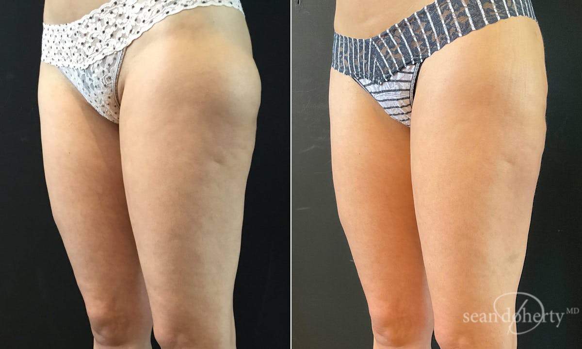 Liposuction Before & After Gallery - Patient 262974 - Image 3