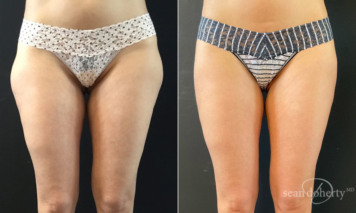 Liposuction Before & After Gallery - Patient 262974 - Image 1