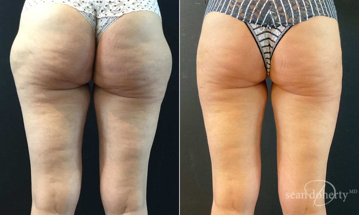 Liposuction Before & After Gallery - Patient 262974 - Image 2
