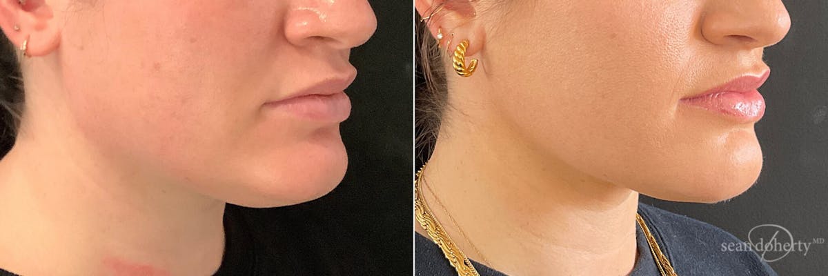 Liposuction Before & After Gallery - Patient 291298 - Image 2