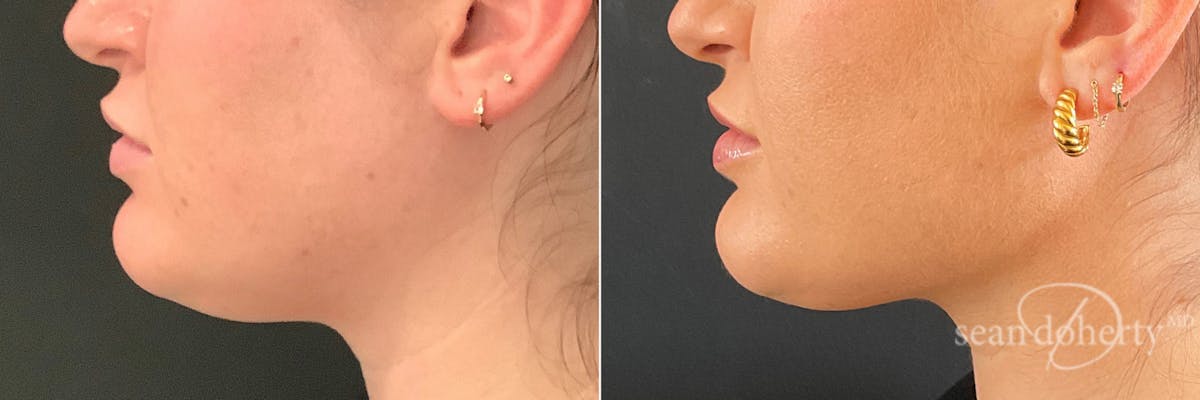 Liposuction Before & After Gallery - Patient 291298 - Image 1