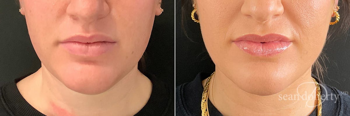 Liposuction Before & After Gallery - Patient 291298 - Image 3