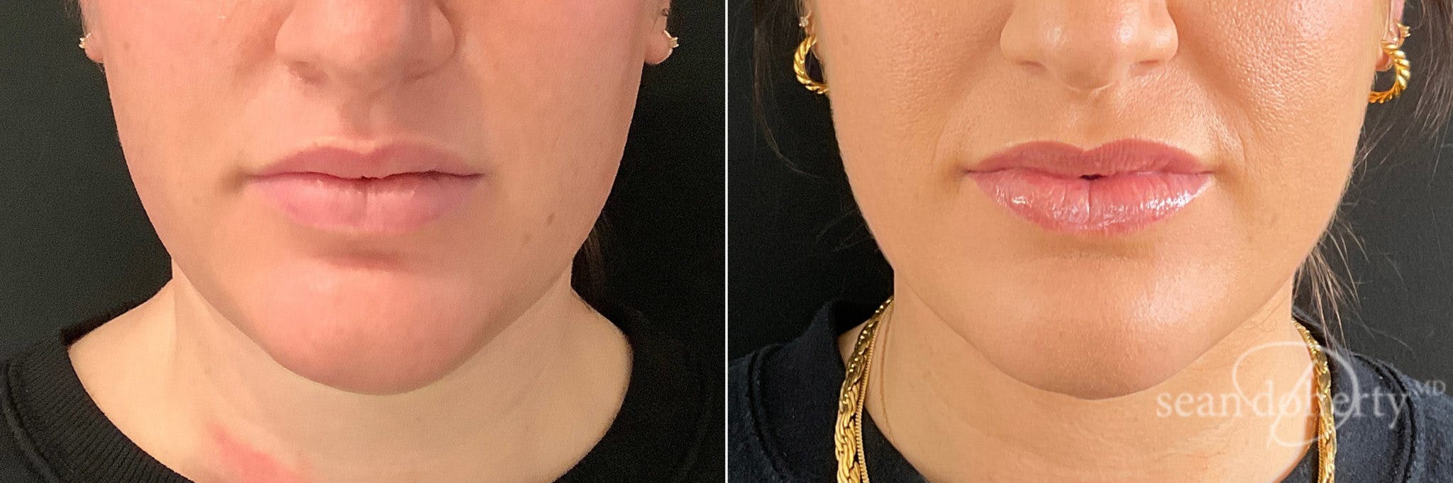 Liposuction Before & After Gallery - Patient 291298 - Image 3