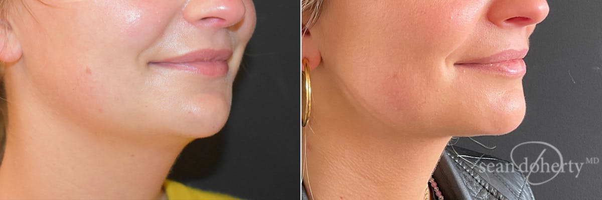 Liposuction Before & After Gallery - Patient 321614 - Image 3