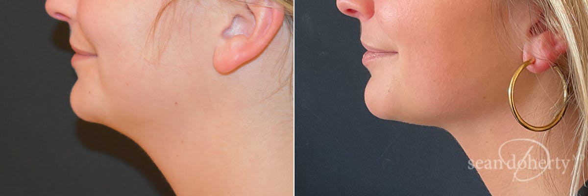 Liposuction Before & After Gallery - Patient 321614 - Image 2