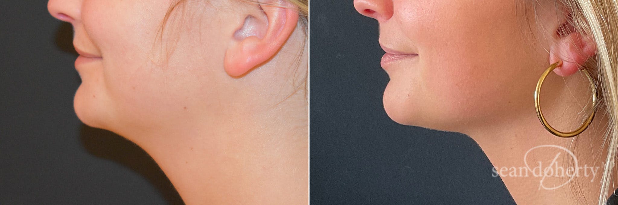 Liposuction Before & After Gallery - Patient 321614 - Image 2