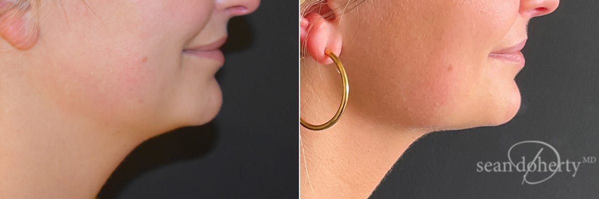 Liposuction Before & After Gallery - Patient 321614 - Image 1