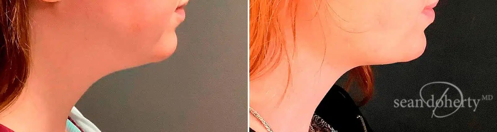 Liposuction Before & After Gallery - Patient 179139 - Image 1