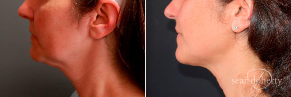 Liposuction Before & After Gallery - Patient 409826 - Image 1