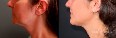 Liposuction Before & After Gallery - Patient 409826 - Image 1