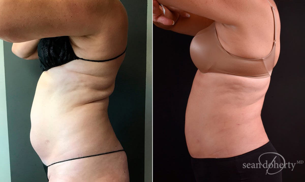 Liposuction Before & After Gallery - Patient 422504 - Image 3