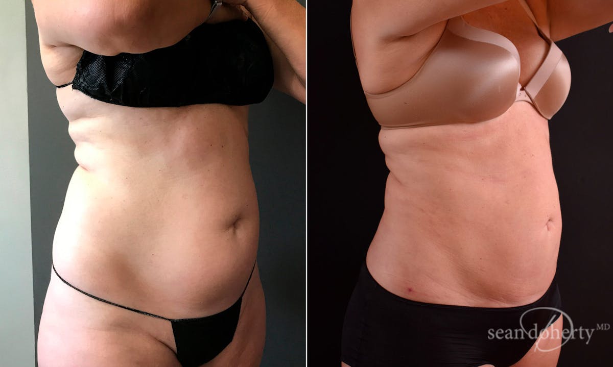 Liposuction Before & After Gallery - Patient 422504 - Image 2