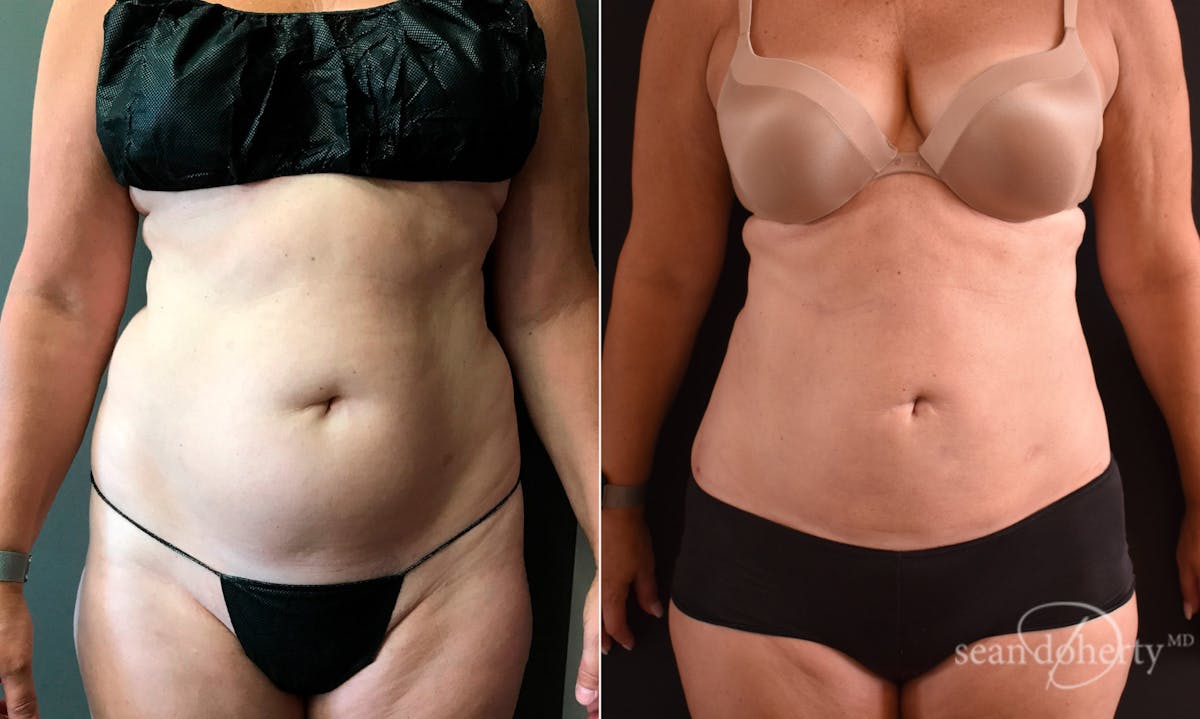 Liposuction Before & After Gallery - Patient 422504 - Image 1