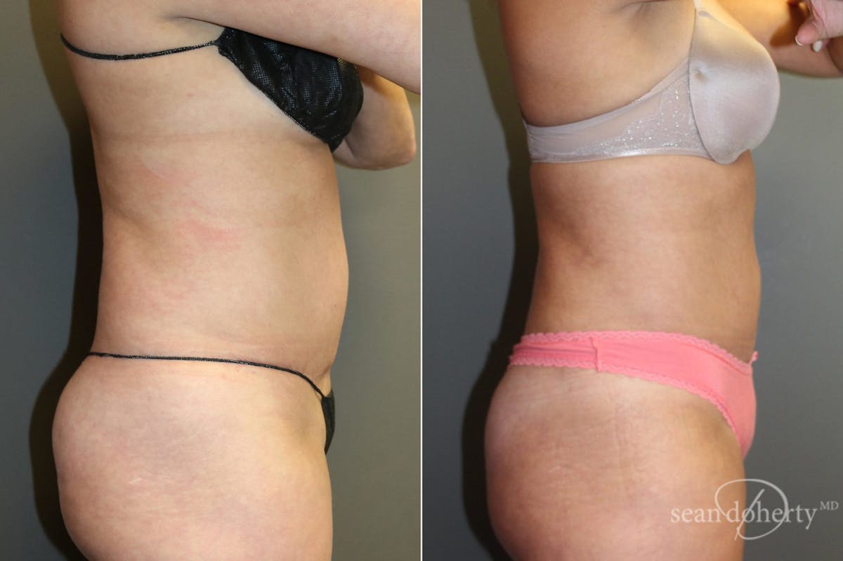 Liposuction Before & After Gallery - Patient 125805 - Image 3