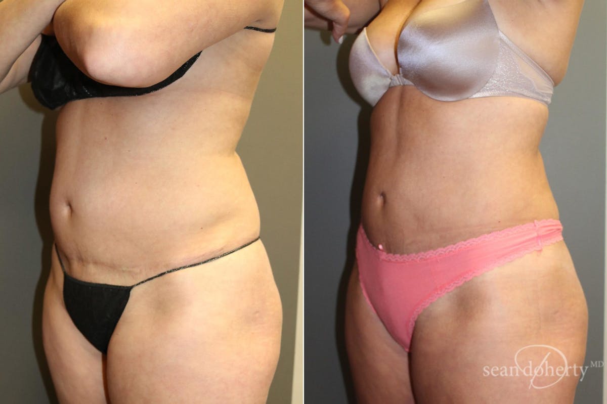 Liposuction Before & After Gallery - Patient 125805 - Image 2