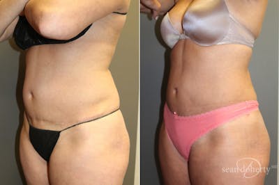 Liposuction and Fat Transfer Before & After Gallery - Patient 125805 - Image 2