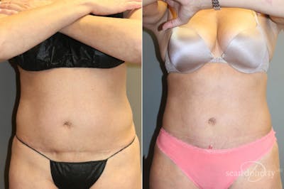 Liposuction Before & After Gallery - Patient 125805 - Image 1