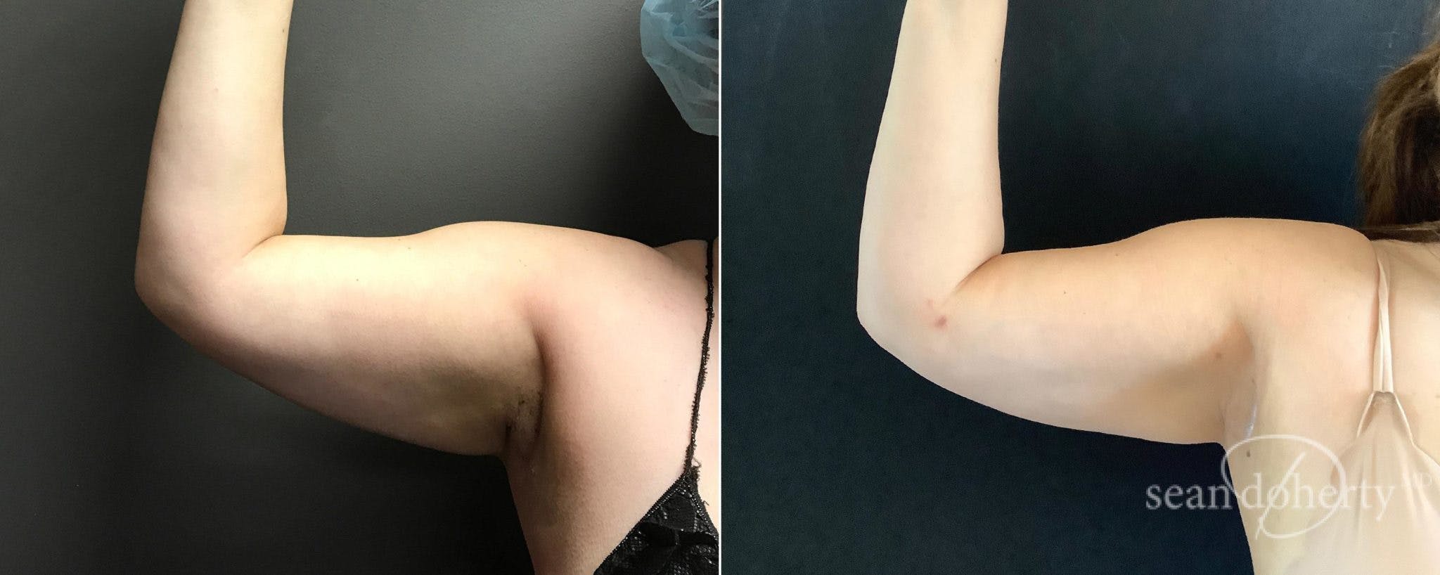 Liposuction Before & After Gallery - Patient 209439 - Image 4