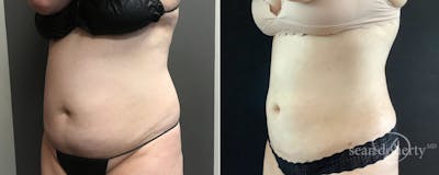 Liposuction and Fat Transfer Before & After Gallery - Patient 209439 - Image 2