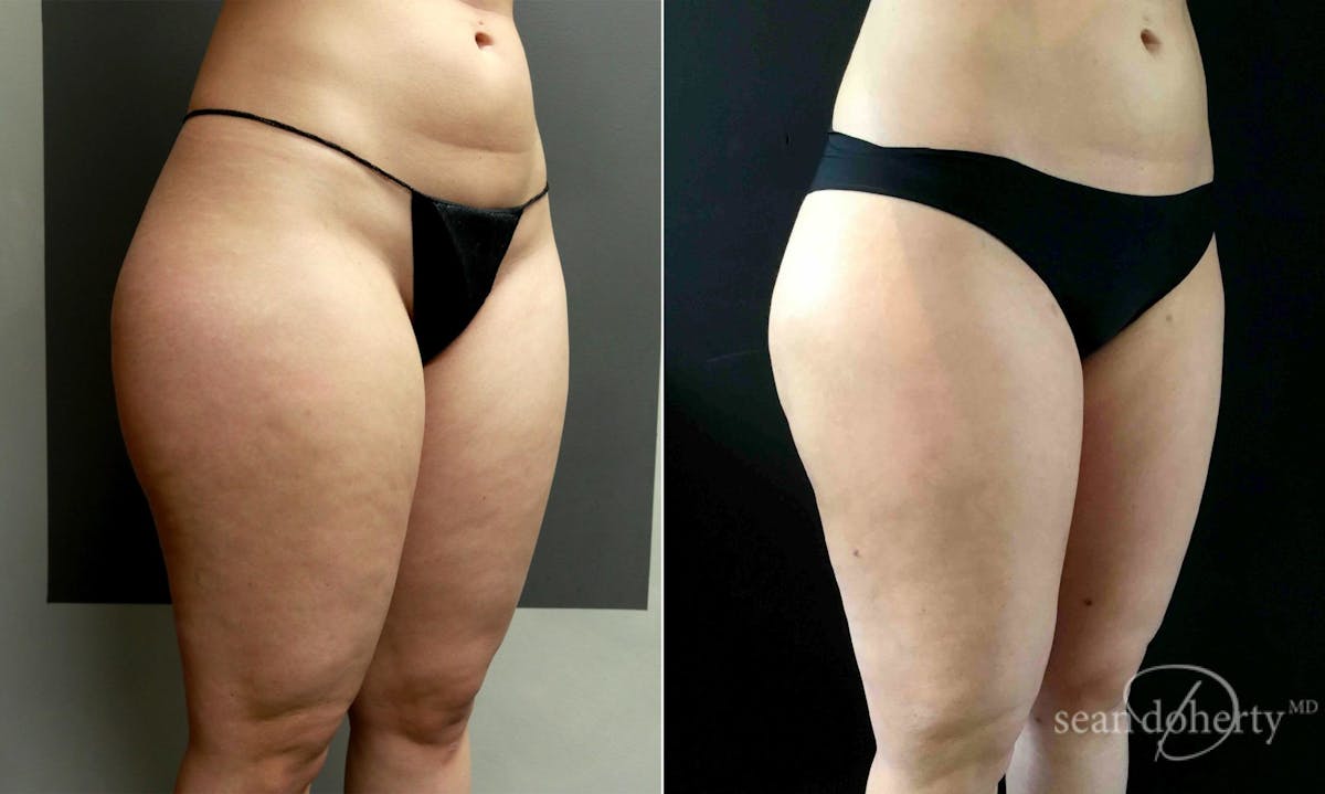 Liposuction Before & After Gallery - Patient 528286 - Image 3