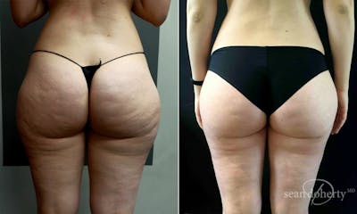 Liposuction and Fat Transfer Before & After Gallery - Patient 528286 - Image 2