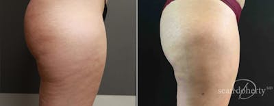 Liposuction and Fat Transfer Before & After Gallery - Patient 238737 - Image 2