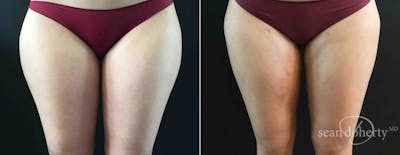 Liposuction Before & After Gallery - Patient 238737 - Image 1