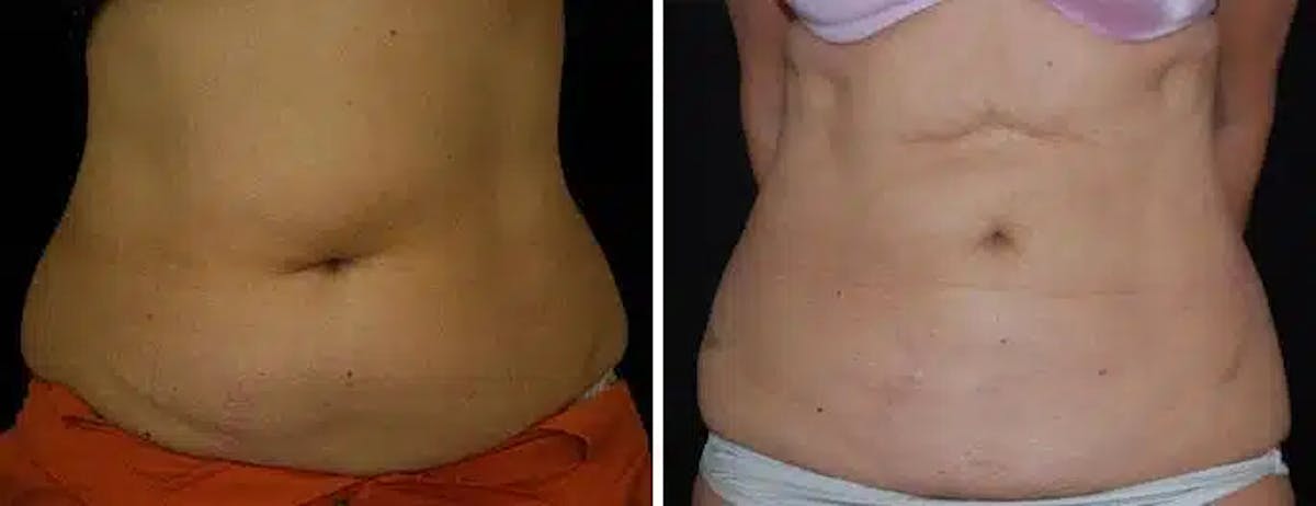Liposuction Before & After Gallery - Patient 773769 - Image 1