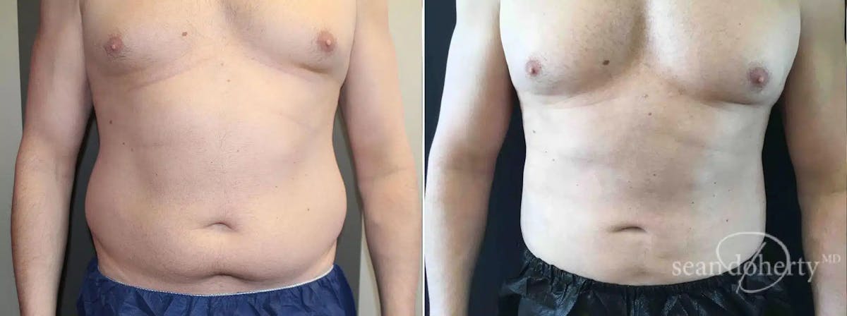 Male Liposuction Before & After Gallery - Patient 341341 - Image 1