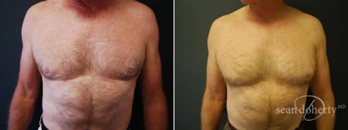 Male Liposuction Before & After Gallery - Patient 257091 - Image 1