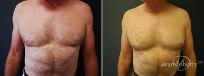 Male Liposuction Before & After Gallery - Patient 257091 - Image 1