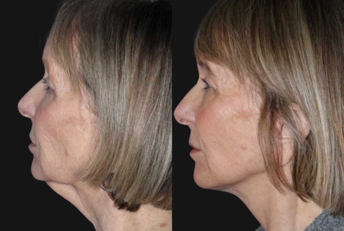 Facelift Before & After Gallery - Patient 403269 - Image 2