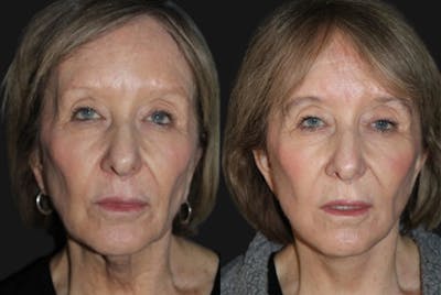 Facelift Before & After Gallery - Patient 403269 - Image 1