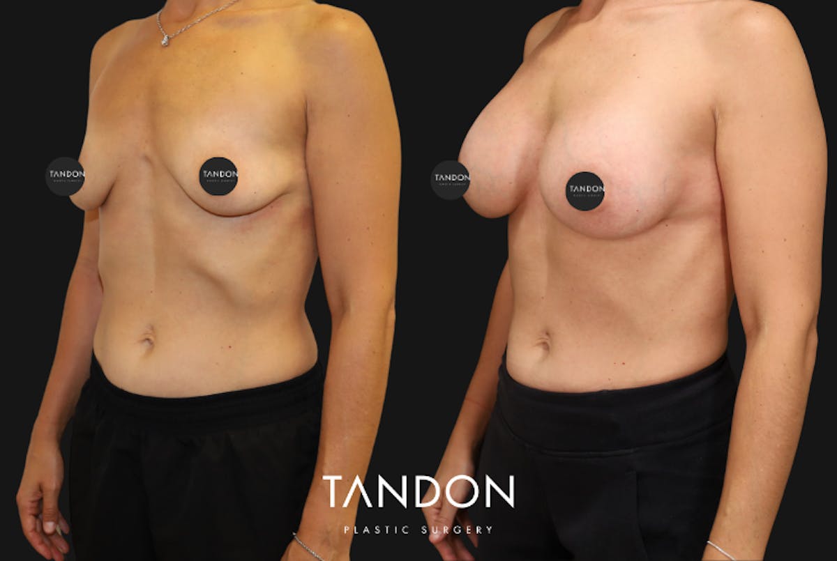 Breast Augmentation Before & After Gallery - Patient 336148 - Image 2