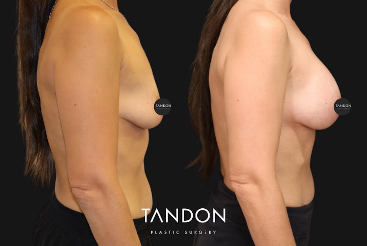 Breast Augmentation Before & After Gallery - Patient 336148 - Image 3