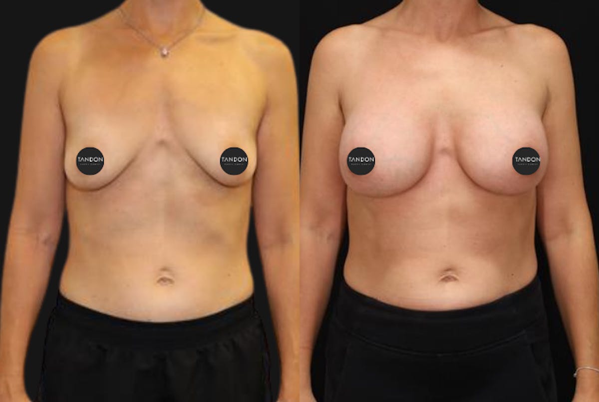 Breast Augmentation Before & After Gallery - Patient 336148 - Image 1