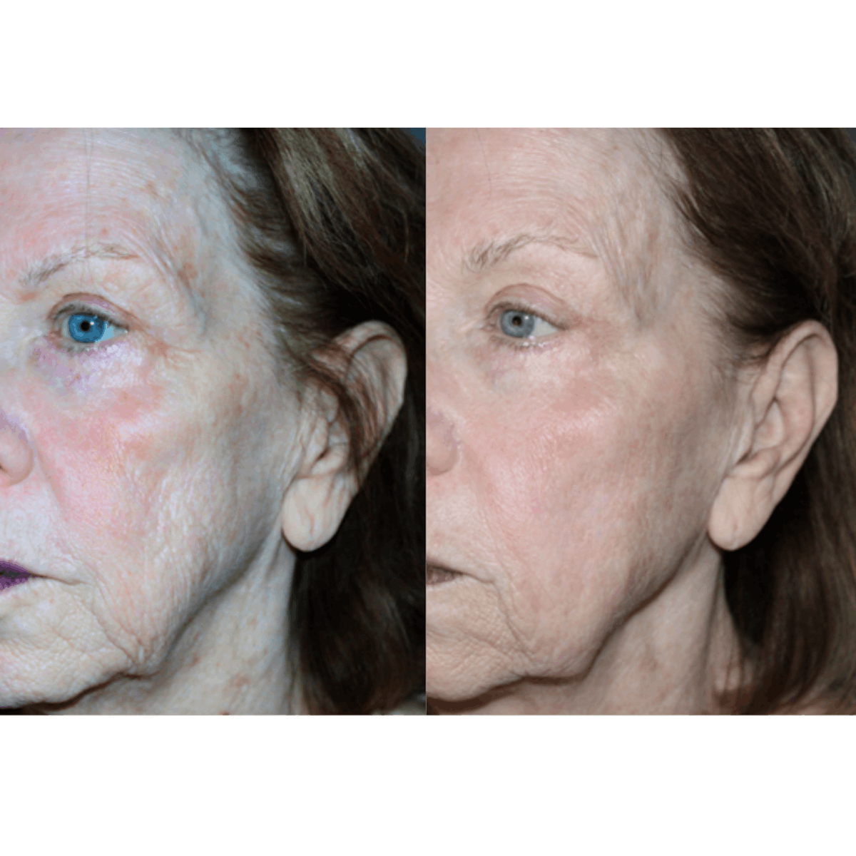 before and after for microneedlingRF by Cheryl