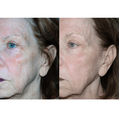 before and after for microneedlingRF by Cheryl