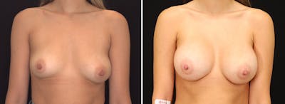 Breast Augmentation Before & After Gallery - Patient 406759 - Image 1
