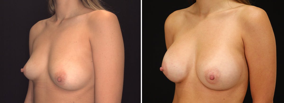 Breast Augmentation Before & After Gallery - Patient 406759 - Image 2
