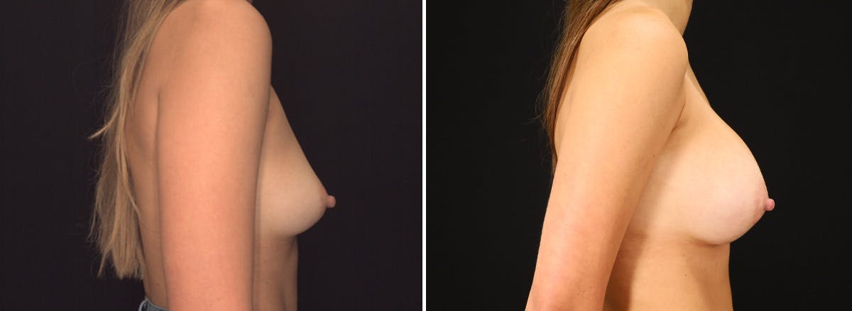 Breast Augmentation Before & After Gallery - Patient 406759 - Image 3