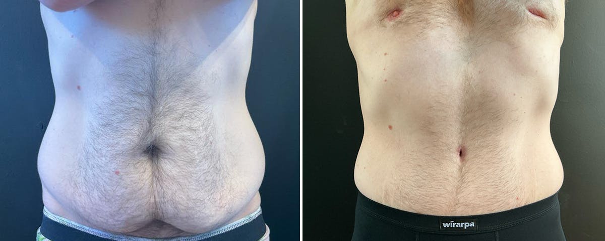 Abdominoplasty (Tummy Tuck) Before & After Gallery - Patient 352675 - Image 1