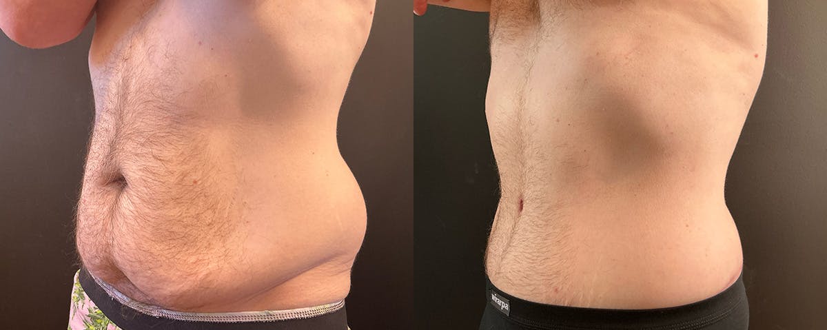 Abdominoplasty (Tummy Tuck) Before & After Gallery - Patient 352675 - Image 2