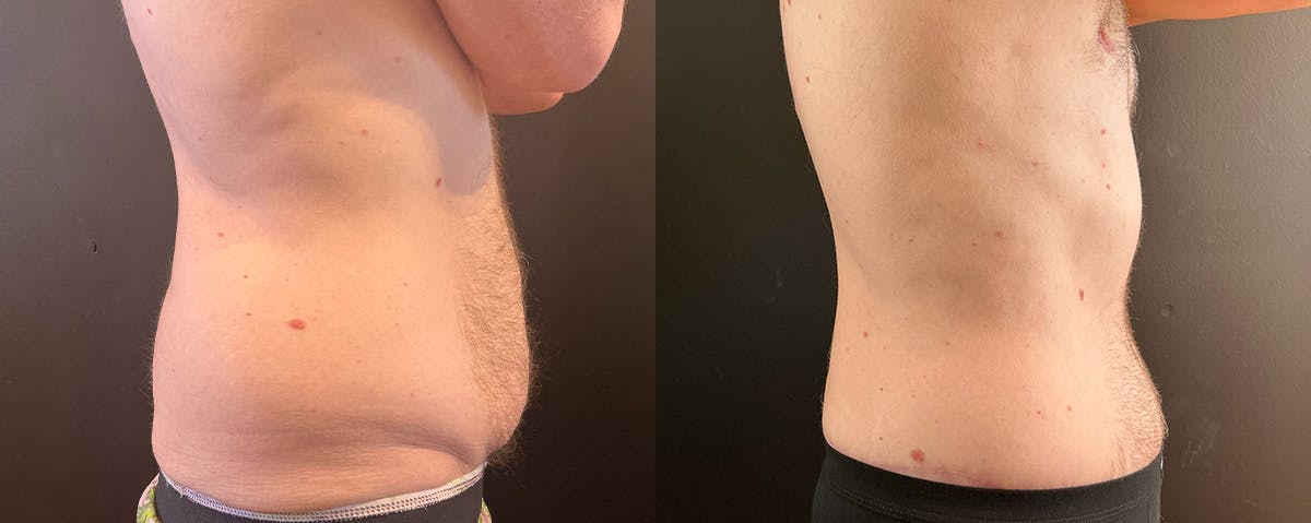 Abdominoplasty (Tummy Tuck) Before & After Gallery - Patient 352675 - Image 3