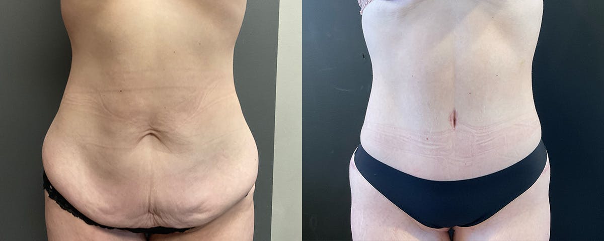Abdominoplasty (Tummy Tuck) Before & After Gallery - Patient 287545 - Image 1