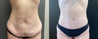 Abdominoplasty (Tummy Tuck) Before & After Gallery - Patient 287545 - Image 1